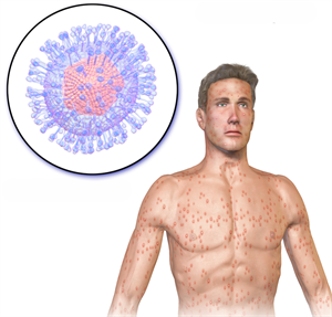 chickenpox edited.png