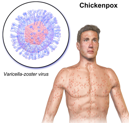 800pxChickenpox (1).png