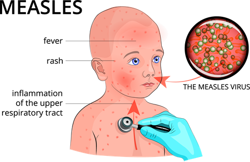 shutterstock_437368534 (measles).png