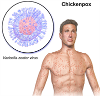 800pxChickenpox1.png