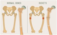 rickets.jpg