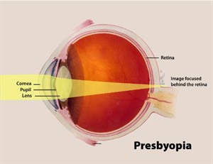 presbyopia (1).jpg
