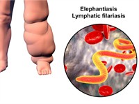 filariasis.jpg